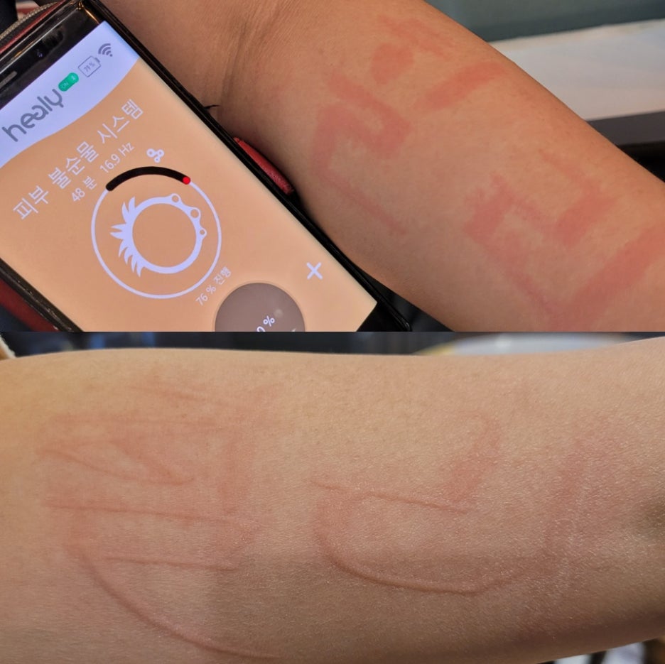 아토피가 심한 피부를 가진 사람이 양쪽 팔에 힐리라는 글자를 손톱으로 긁어서 표시하니 붉게 팔뚝에 힐리라는 글자가 새겨졌습니다.